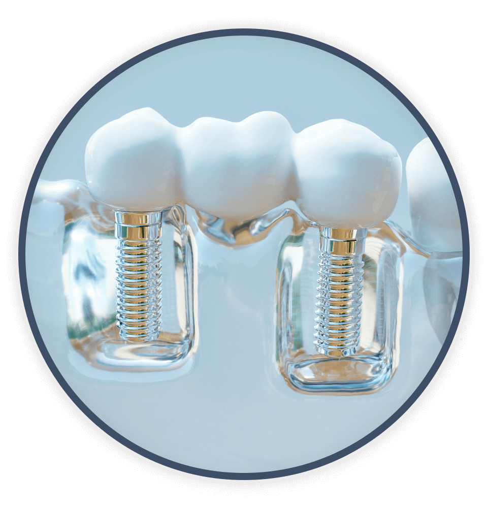 dental implant bridge 3d model