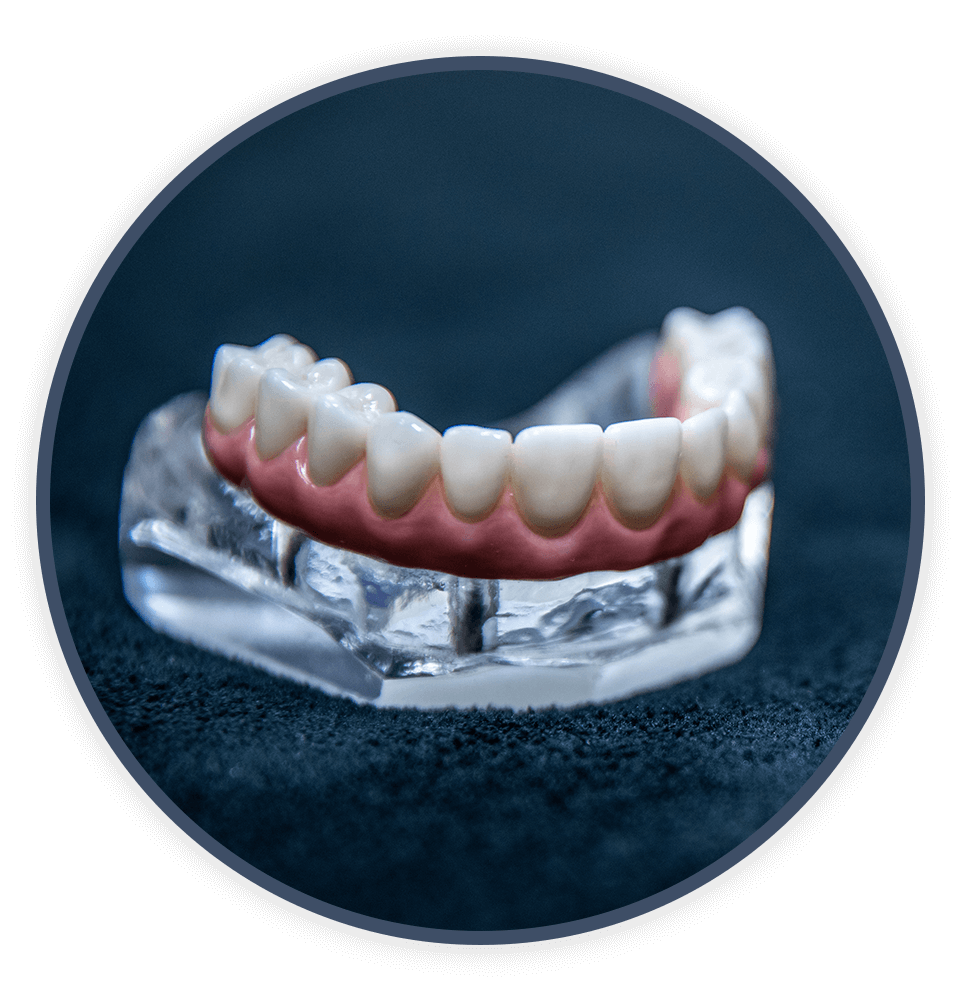 full mouth dental implants model
