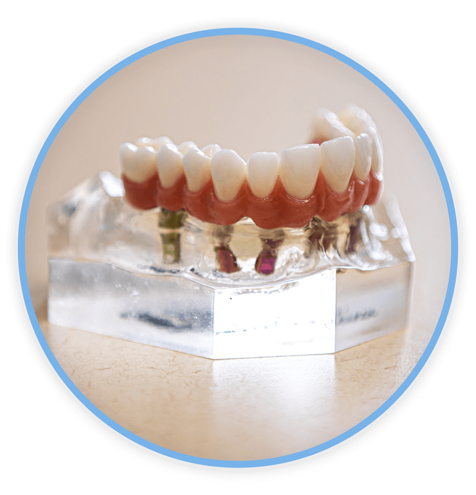 full arch dental implants model