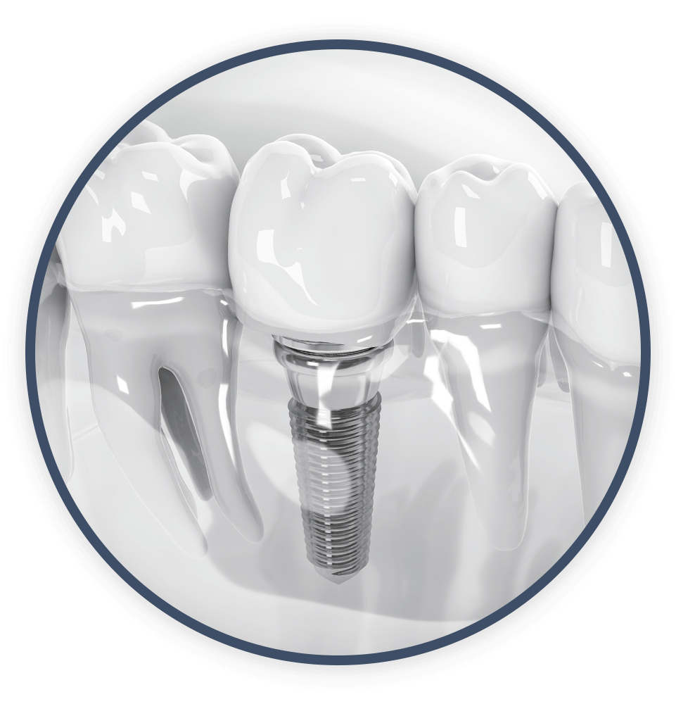 single dental implant 3d model