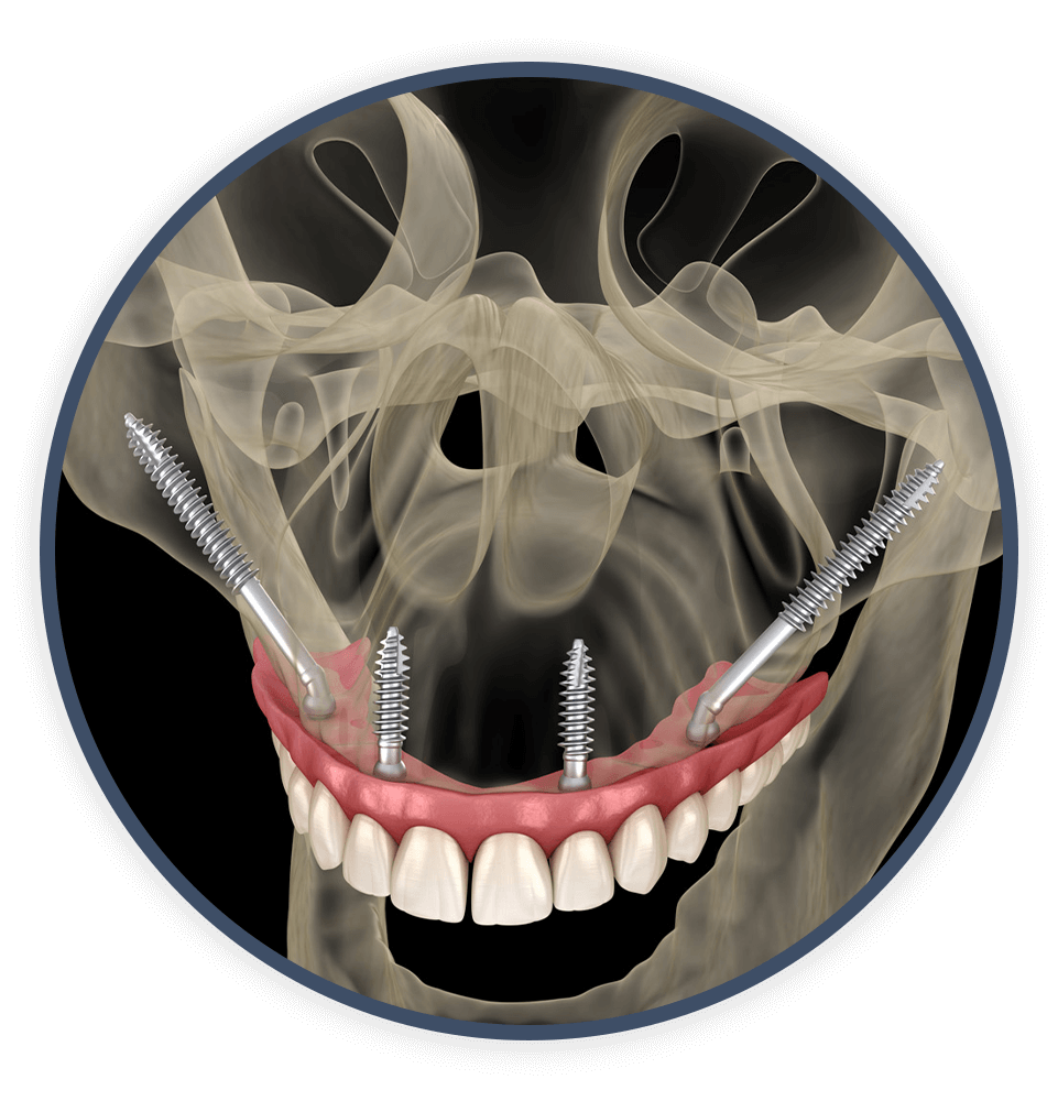 zygomatic dental implants 3d model